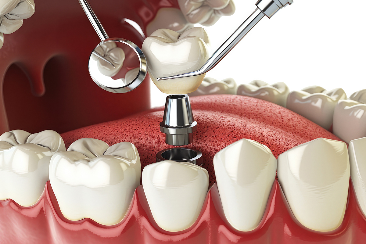 3d render dental implant being installed into model gum