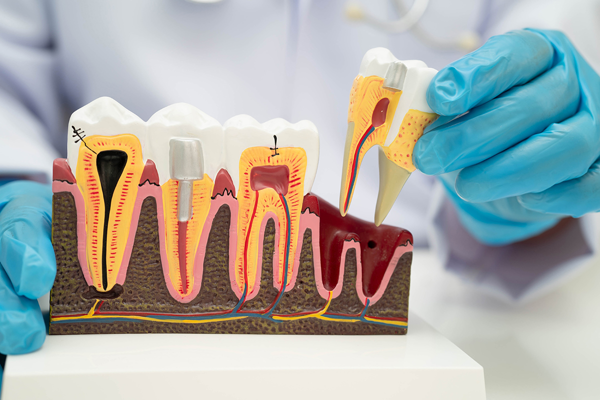 Dentist holding dental implant artificial tooth roots into jaw root canal dental treatment gum disease teeth model dentist